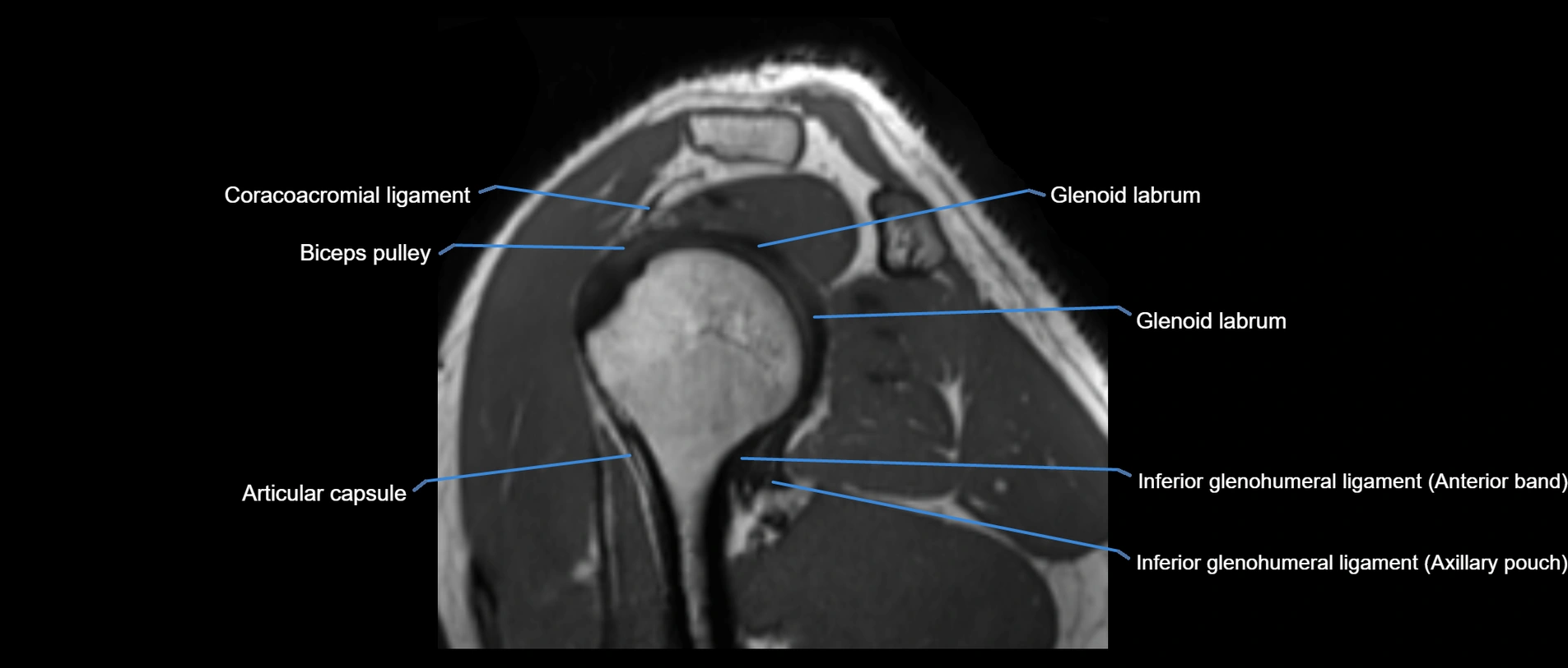 shoulder ligaments sagittal  cross sectional anatomy 3T MRI AI enhanced radiology image -img-00001-00033.webp